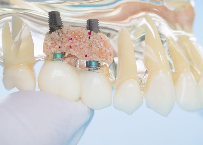 Bone Grafting
