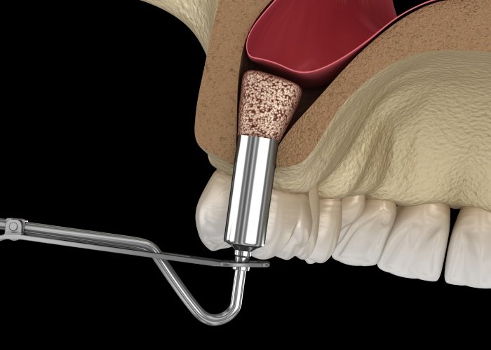 Closed Sinus Lift