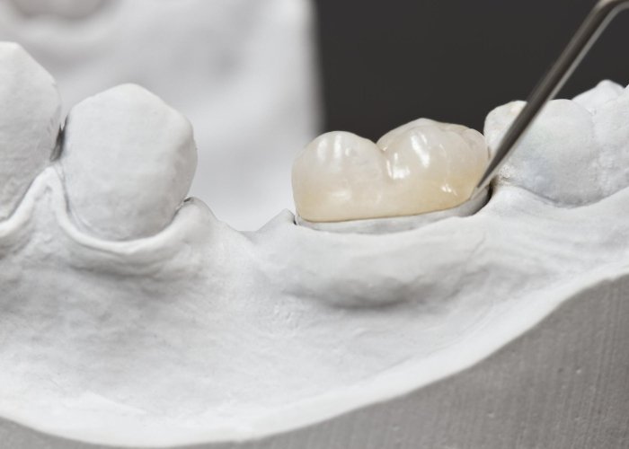 Inlays and Onlays treatment