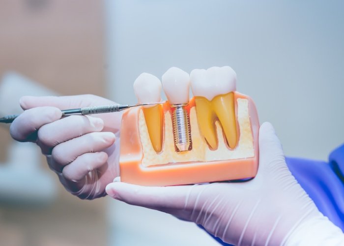 Single-Tooth Dental Implants