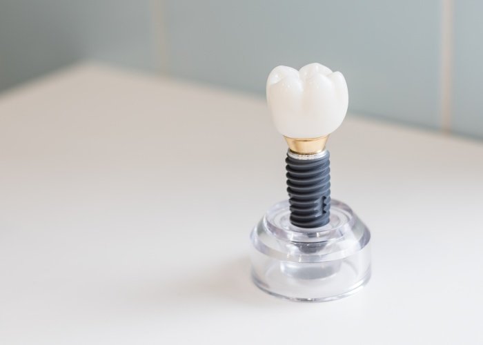 Titanium dental implants