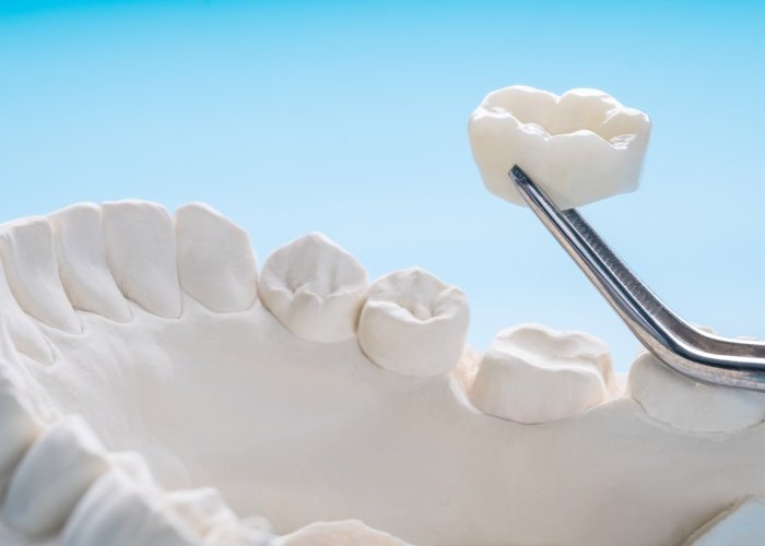 Types of Dental Crowns