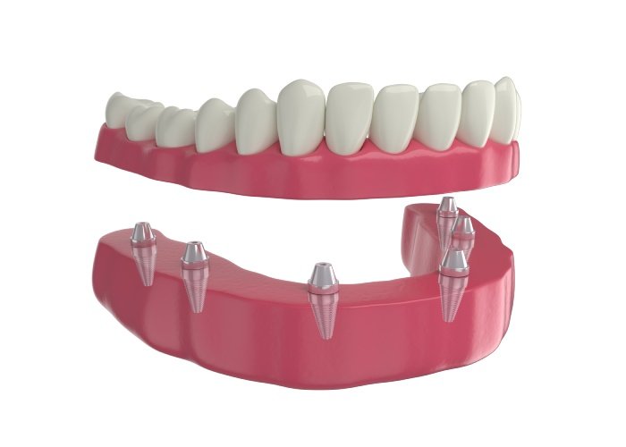 denture