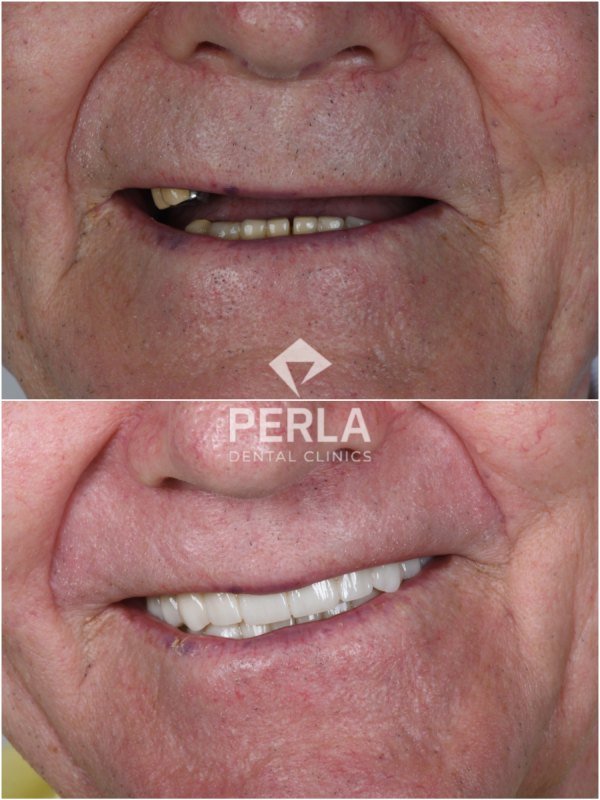 All-on-4 Dental Implants in Turkey before and after