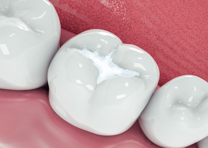 Dental Filling in Turkey