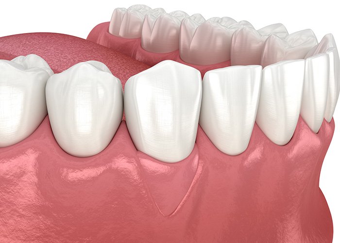 Gum graft surgery step 3