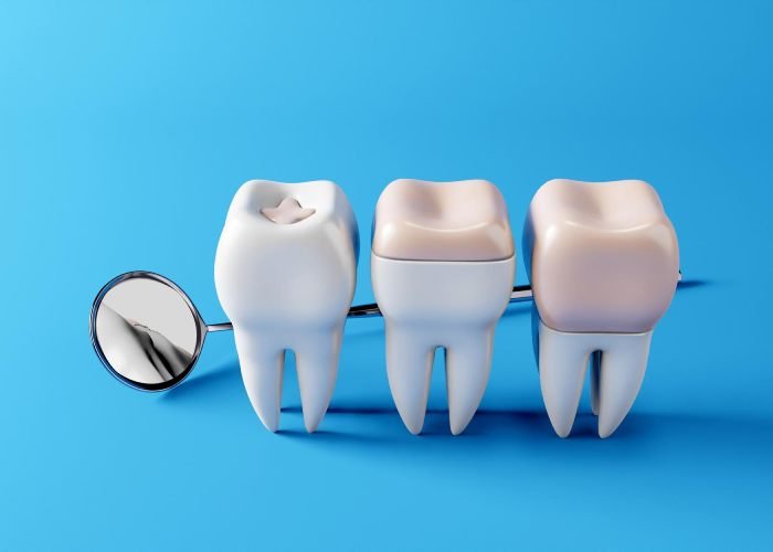 How Much Does a Dental Filling Cost