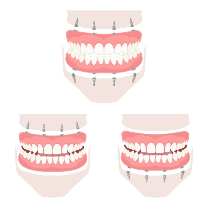 Removable denture of the upper and lower jaw