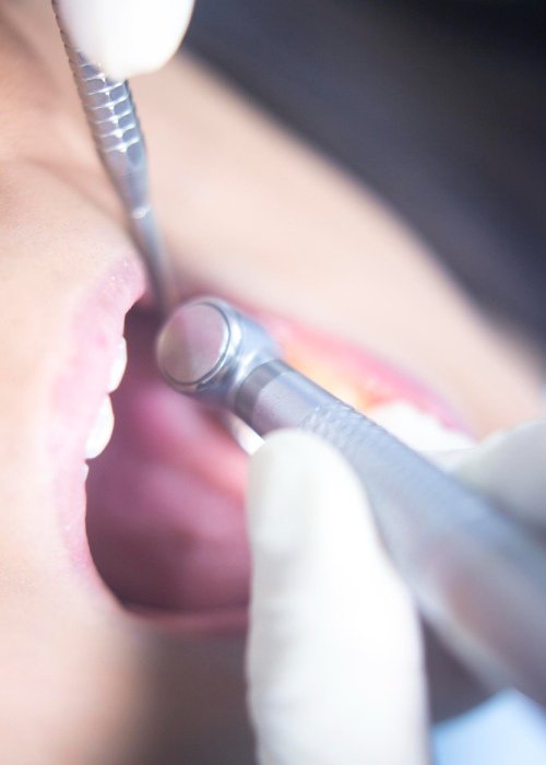 The Dental Filling Procedure