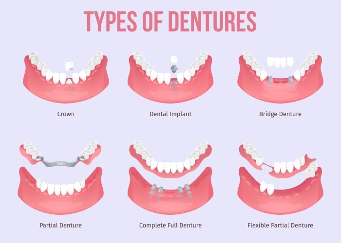 Types of Dentures