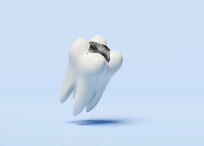 amalgam fillings