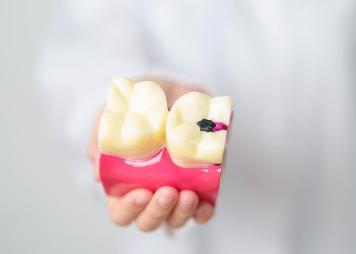 cost of dental cavity filling