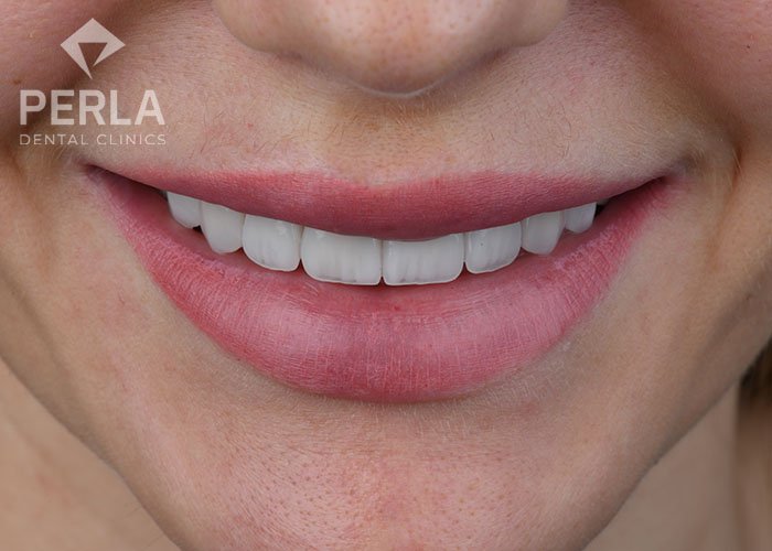 emax crown in perla dental clinics