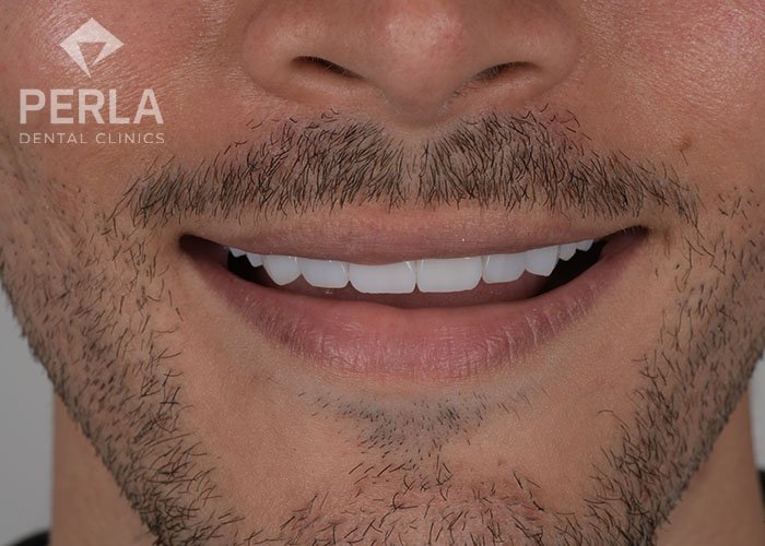 emax crown in perla dental clinics