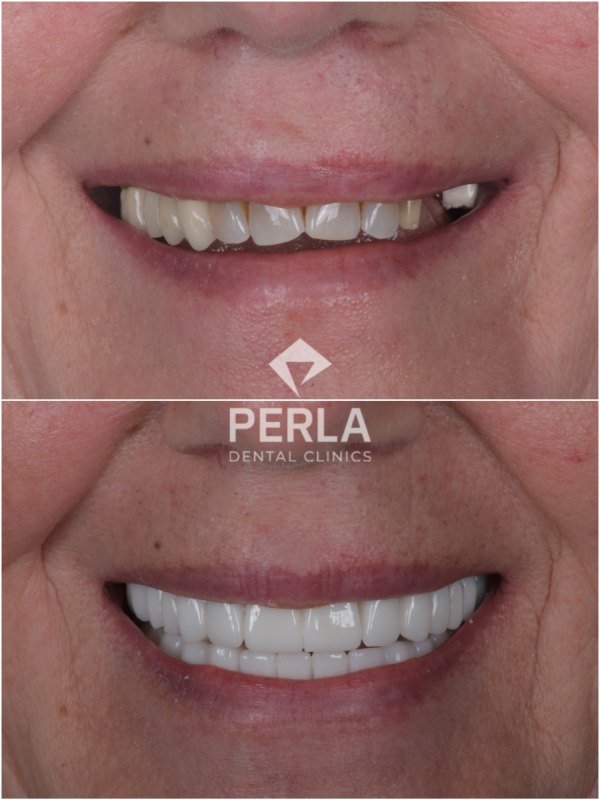 smile before and after All-on-4 Dental Implants