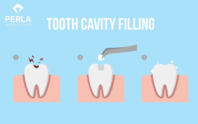 tooth cavity filling