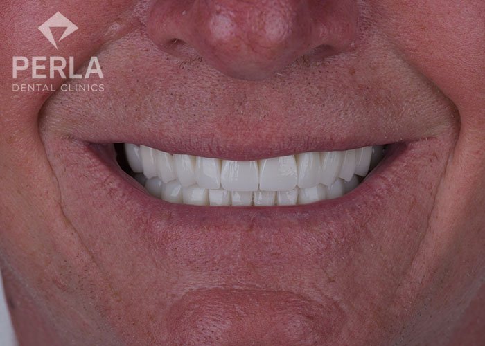 zirconia dental crowns in perla dental turkey