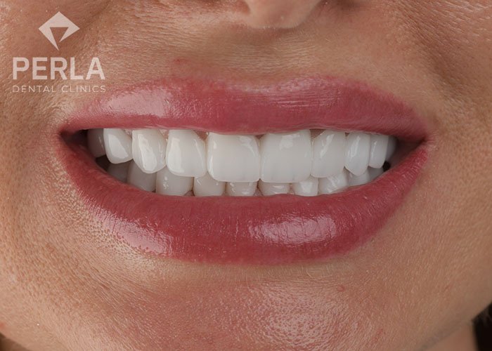 zirconia dental crowns in perla dental turkey