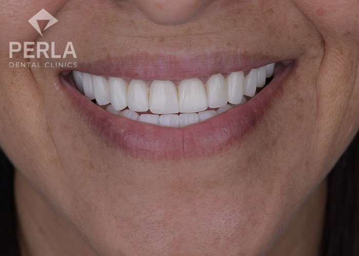 zirconia dental crowns in perla dental turkey