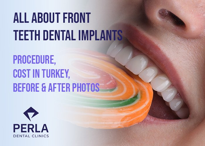 Dental Holiday in Antalya, Turkey: Prices & Packages for Dental Tourism All About Front Teeth Dental Implants Procedure, Cost in Turkey, Before and After