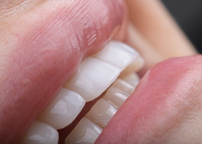 All About Front Teeth Dental Implants: Procedure, Cost in Turkey, Before & After All About Front Teeth Dental Implants