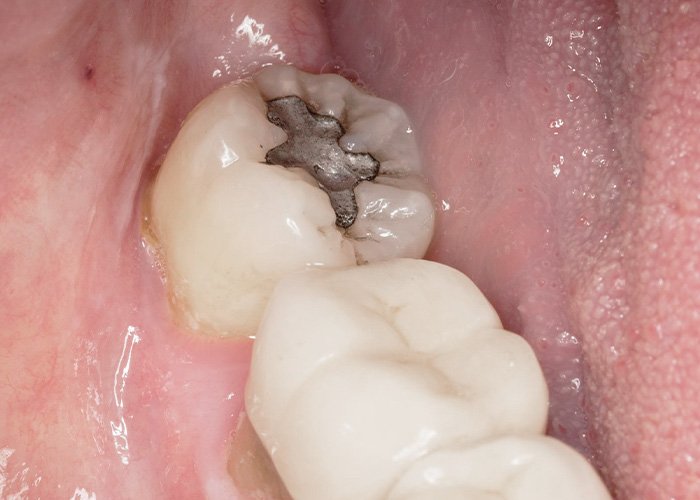 Amalgam Fillings: Everything You Need to Know About Treatment Amalgam Filling Placement