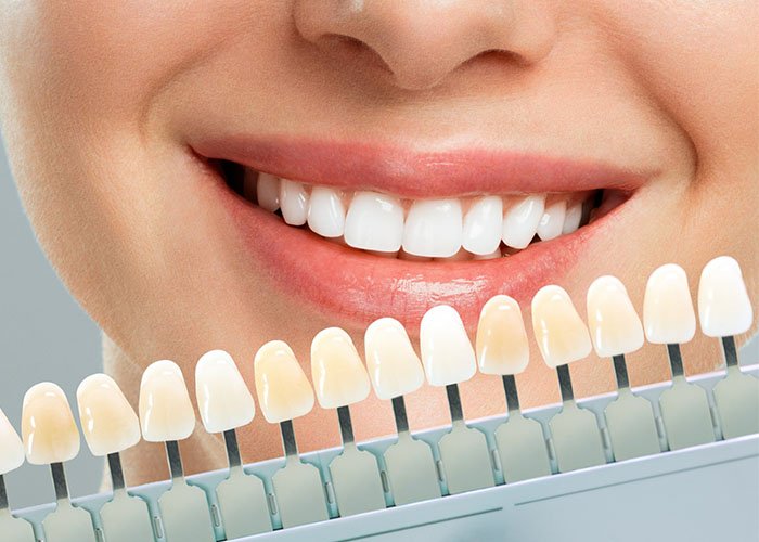 Benefits of Porcelain Veneers