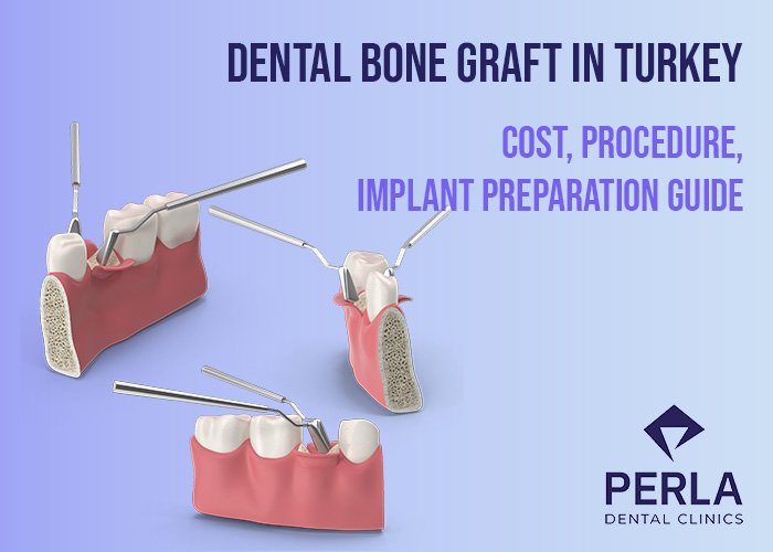 3 on 6 Dental Implants Dental Bone Graft in Turkey Cost, Procedure, Implant Preparation Guide