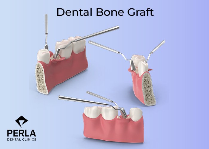 Dental Bone Graft in Turkey: Cost, Procedure, and Implant Preparation Guide Dental Bone Graft in Turkey