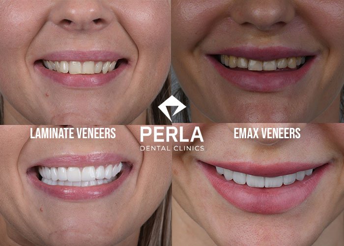 Dental Lumineers and Veneers How to Choose the Right Option