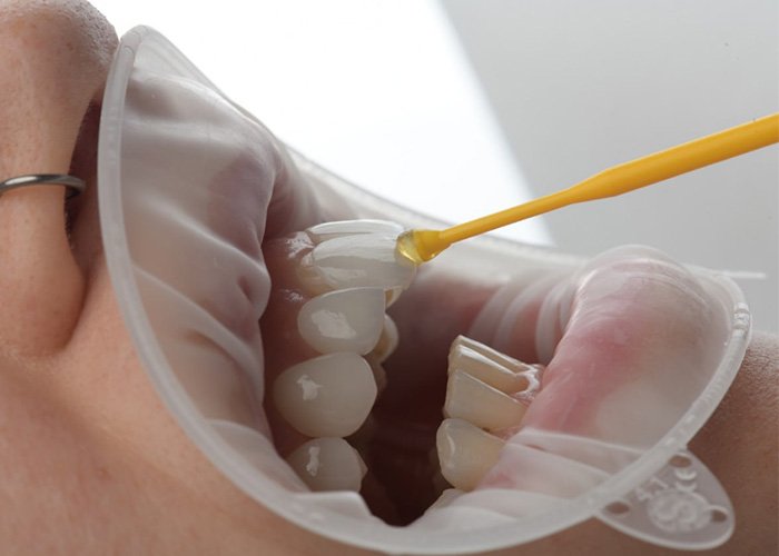 Dental Lumineers in Turkey