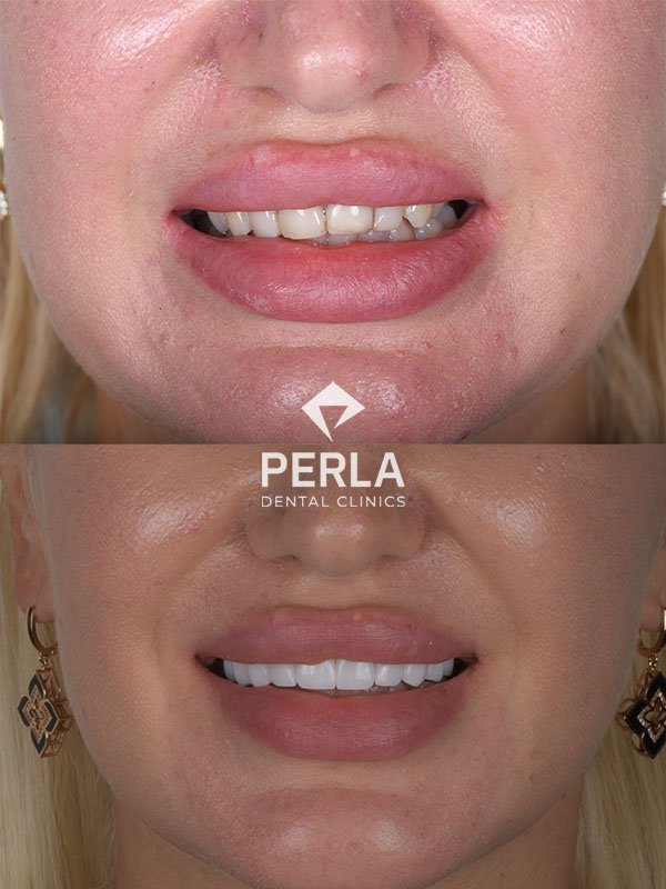 All About Front Teeth Dental Implants: Procedure, Cost in Turkey, Before & After Front Teeth Dental Implants before and after 1