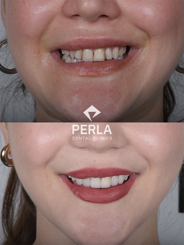 All About Front Teeth Dental Implants: Procedure, Cost in Turkey, Before & After Front Teeth Dental Implants before and after in Antalya 1