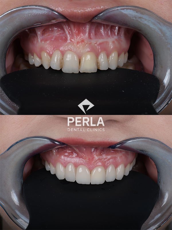 All About Front Teeth Dental Implants: Procedure, Cost in Turkey, Before & After Front Teeth Dental Implants before and after in Antalya