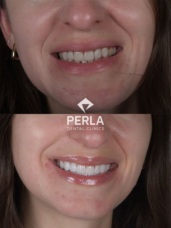 All About Front Teeth Dental Implants: Procedure, Cost in Turkey, Before & After Front Teeth Dental Implants before and after in Turkey 1