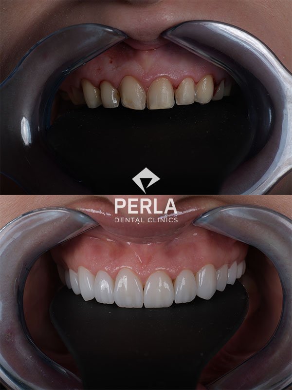 All About Front Teeth Dental Implants: Procedure, Cost in Turkey, Before & After Front Teeth Dental Implants before and after in Turkey