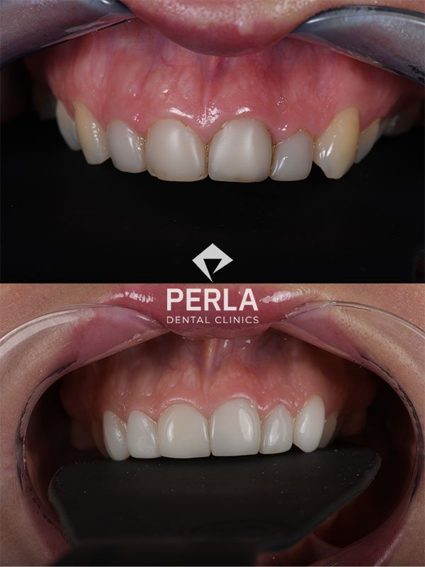 All About Front Teeth Dental Implants: Procedure, Cost in Turkey, Before & After Front Teeth Dental Implants before and after