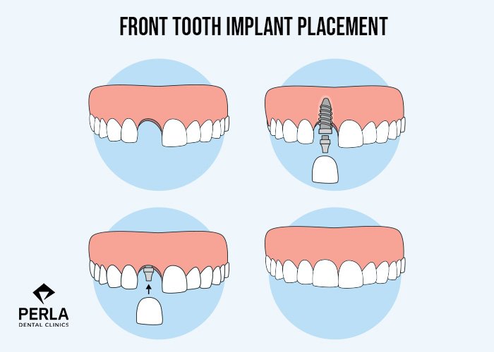 All About Front Teeth Dental Implants: Procedure, Cost in Turkey, Before & After Front Tooth Implant Placement