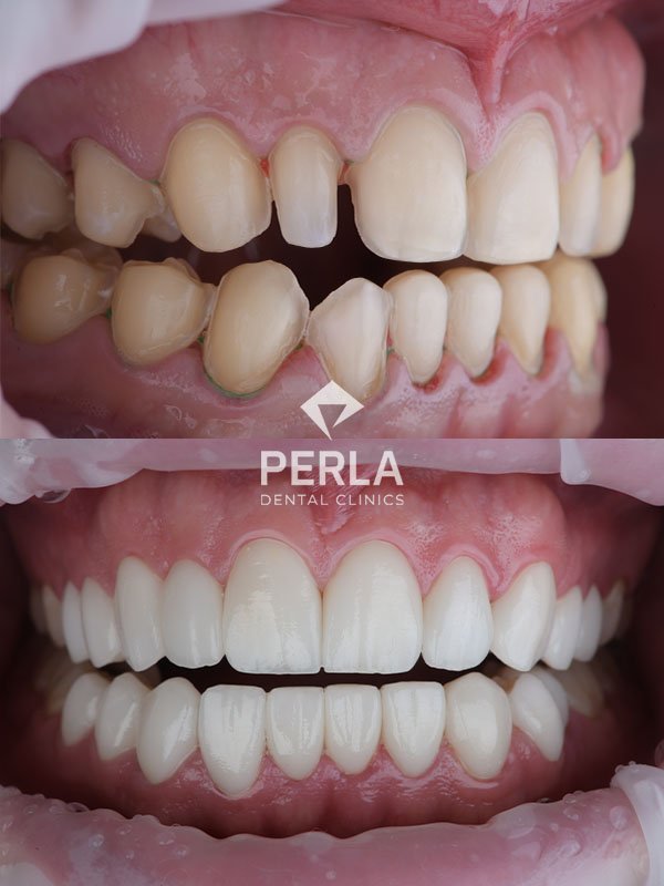 How Can Dental Lumineers Help You