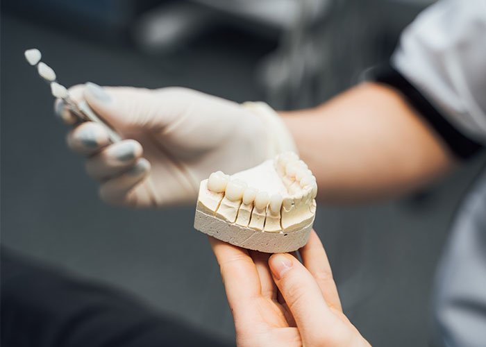 Longevity Maintenance and Repairs of crowns and veneers