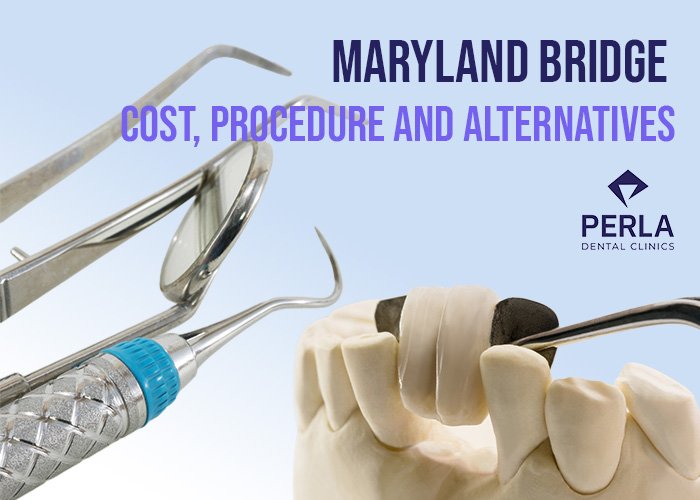 Maryland Bridge Cost, Procedure Alternatives Perla Dental Clinic
