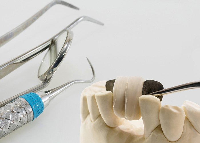 Maryland Bridge Cost, Procedure and Alternatives