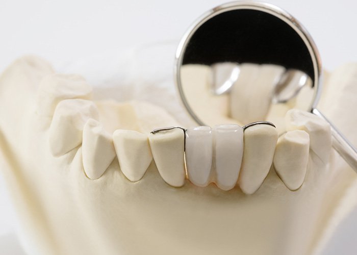 Maryland Dental Bridge Replaces Missing Teeth