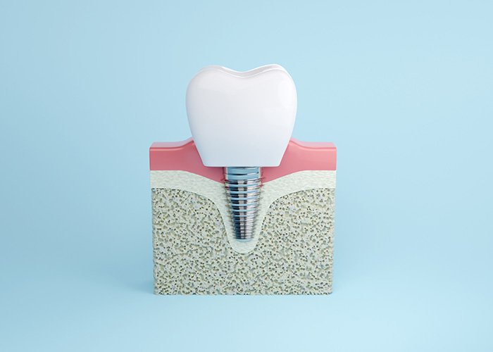 All About Front Teeth Dental Implants: Procedure, Cost in Turkey, Before & After Mini Implants