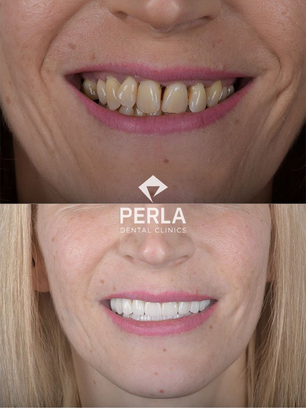 Oral and Maxillofacial Surgery Perla Dental Antalya Turkey