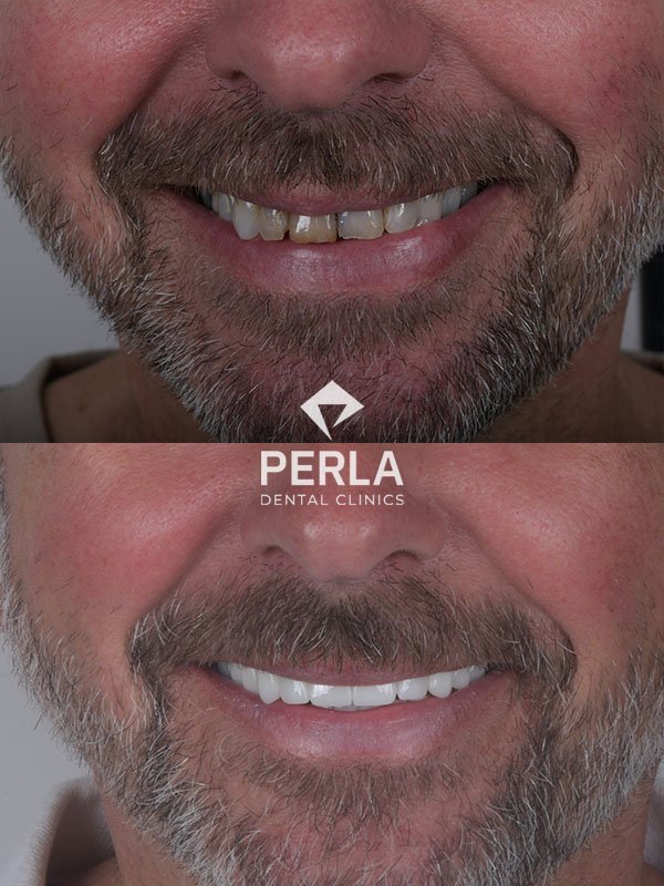 Oral and Maxillofacial Surgery Perla Dental Antalya