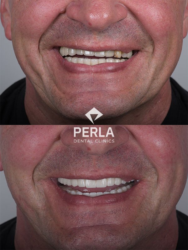 Oral and Maxillofacial Surgery Perla Dental in Antalya