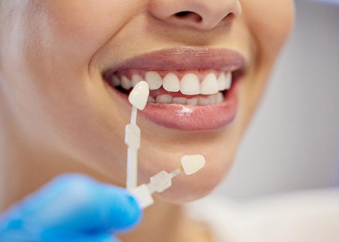 Porcelain Veneers in Turkey