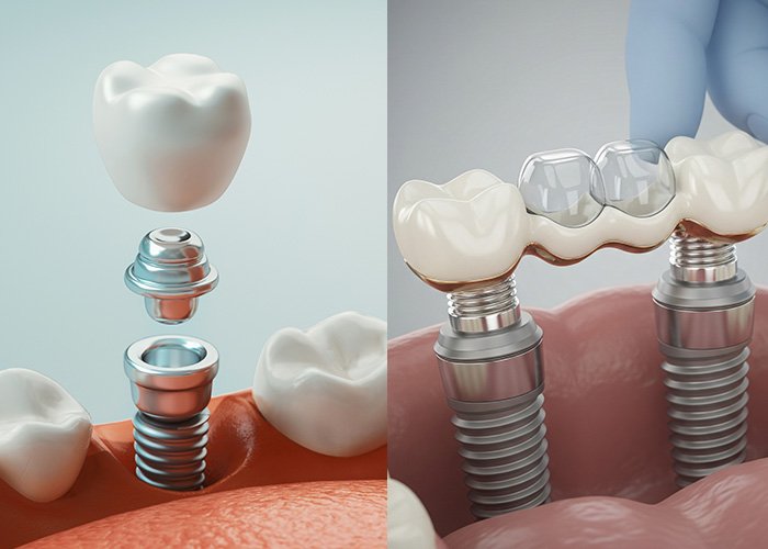 All About Front Teeth Dental Implants: Procedure, Cost in Turkey, Before & After Single Tooth Implant and Implant-Supported Bridge