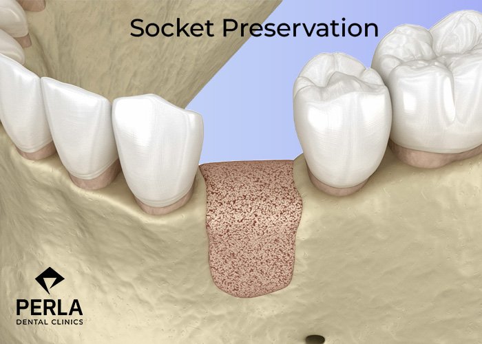 Dental Bone Graft in Turkey: Cost, Procedure, and Implant Preparation Guide Socket Preservation